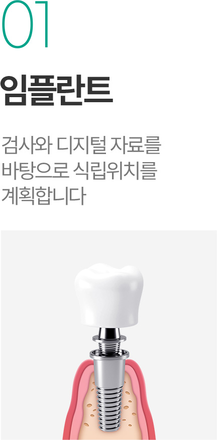 임플란트 - 검사와 디지털 자료를 바탕으로 식립 위치 계획 임플란트 - 검사와 디지털 자료를 바탕으로 식립 위치 계획