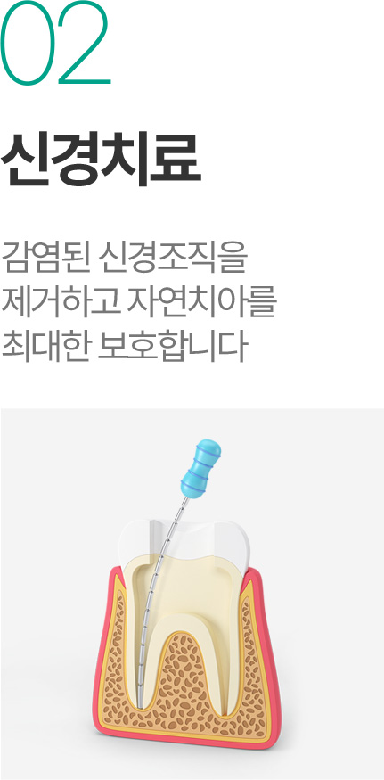 신경치료 - 감염된 신경조직 제거와 자연치아 보호 신경치료 - 감염된 신경조직 제거와 자연치아 보호