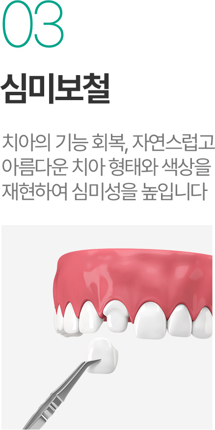 심미보철 - 자연스러운 치아 형태와 색상 재현 심미보철 - 자연스러운 치아 형태와 색상 재현