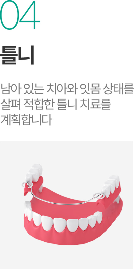 틀니 - 남아 있는 치아와 잇몸 상태에 적합한 틀니 치료 계획 틀니 - 남아 있는 치아와 잇몸 상태에 적합한 틀니 치료 계획