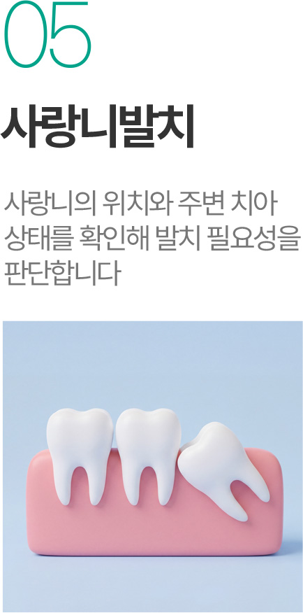 사랑니발치 - 사랑니 위치와 주변 치아 상태를 확인해 발치 필요성 판단 사랑니발치 - 사랑니 위치와 주변 치아 상태를 확인해 발치 필요성 판단