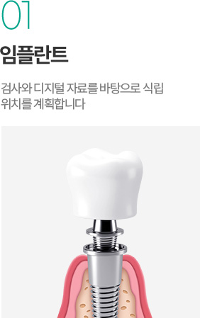 임플란트 - 검사와 디지털 자료를 바탕으로 식립 위치 계획 임플란트 - 검사와 디지털 자료를 바탕으로 식립 위치 계획