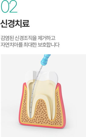 신경치료 - 감염된 신경조직 제거와 자연치아 보호 신경치료 - 감염된 신경조직 제거와 자연치아 보호