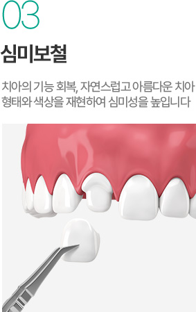 심미보철 - 자연스러운 치아 형태와 색상 재현 심미보철 - 자연스러운 치아 형태와 색상 재현