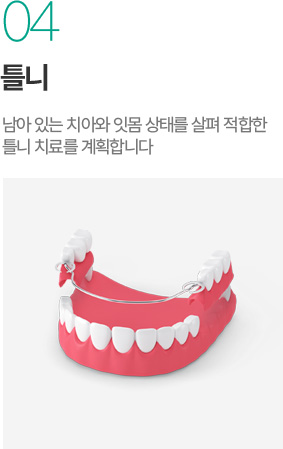 틀니 - 남아 있는 치아와 잇몸 상태에 적합한 틀니 치료 계획 틀니 - 남아 있는 치아와 잇몸 상태에 적합한 틀니 치료 계획