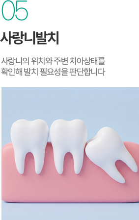 사랑니발치 - 사랑니 위치와 주변 치아 상태를 확인해 발치 필요성 판단 사랑니발치 - 사랑니 위치와 주변 치아 상태를 확인해 발치 필요성 판단